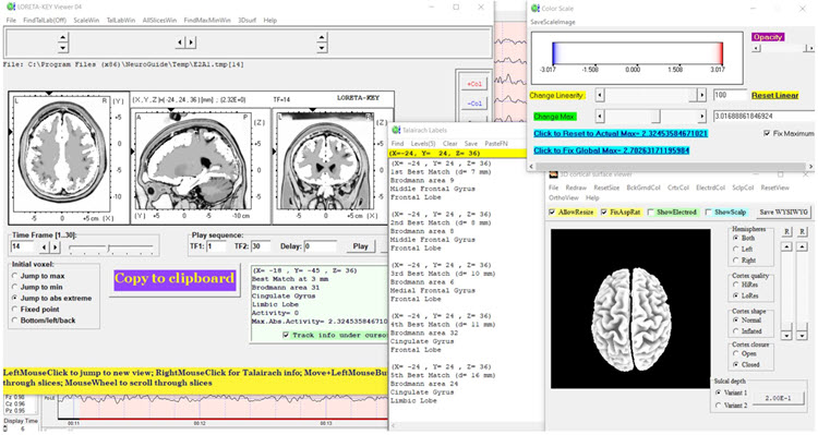 Figure 26 - Post-neurofeedback eyes-open z-score LORETA analysis for 14 Hz showing reduced excess
